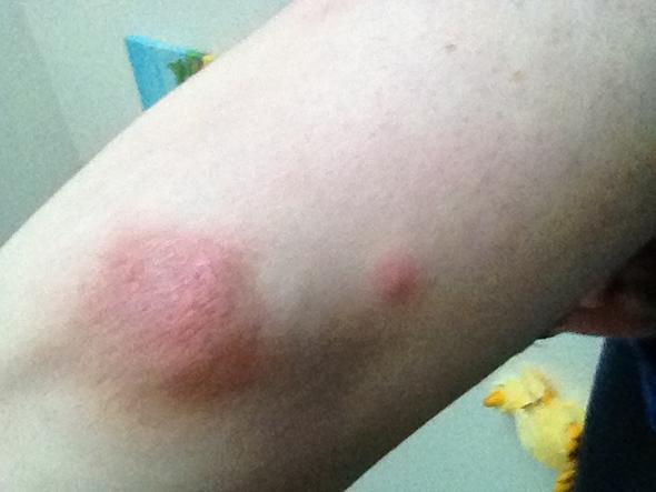 Wandernder Hautausschlag Wie Muckenstiche Haut Juckreiz Ausschlag Wandernder Hautausschlag Wie Muckenstiche Haut Juckreiz Ausschlag