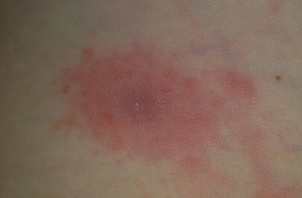 Ist Das Hier Auf Dem Photo Eine Wanderrote Borreliose Zeckenbiss