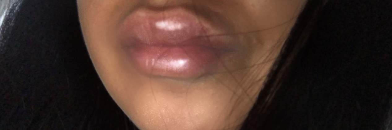 Lippen aufspritzen wie lange geschwollen