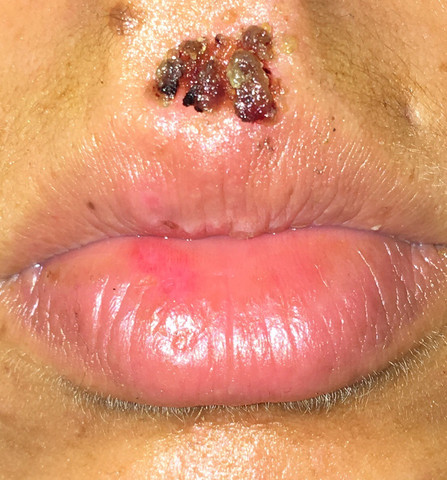 Wann Heilt Meine Herpes Kruste Gesundheit Und Medizin Wann Heilt Meine Herpes Kruste Gesundheit Und Medizin