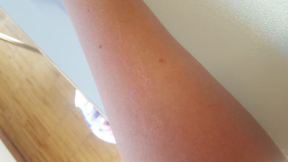 Wann Kann Ich Uber Eine Narbe Tatowieren Lassen Tattoo