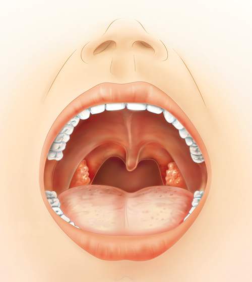 Wann müssen Mandeln entfernt werden? (krank, Erkältung)