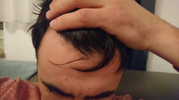 Wann Redet Man Von Haarausfall Gesundheit Haare Korper