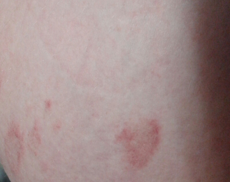 Wann sind das für rote Flecken auf meinem oberschenkel? (jucken, keine) Wann sind das für rote Flecken auf meinem oberschenkel? (jucken, keine)