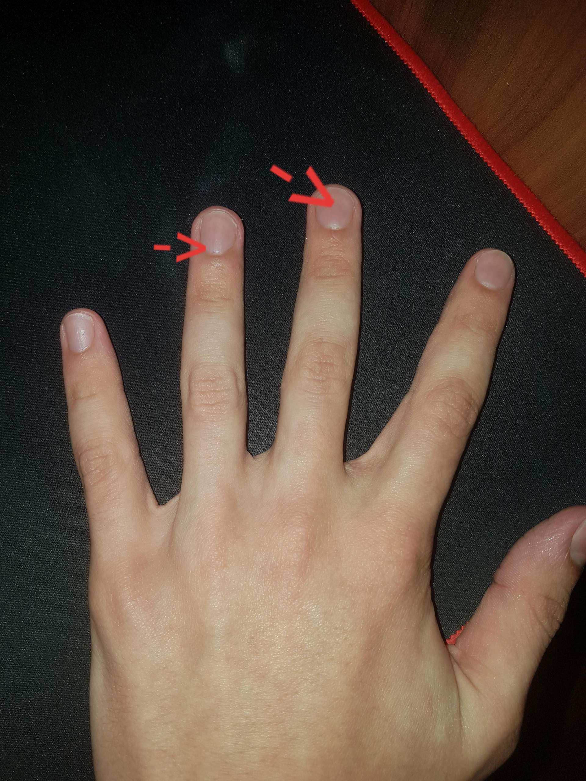Wann wächst die Nagelhaut? (Nägel, Hand, Finger)