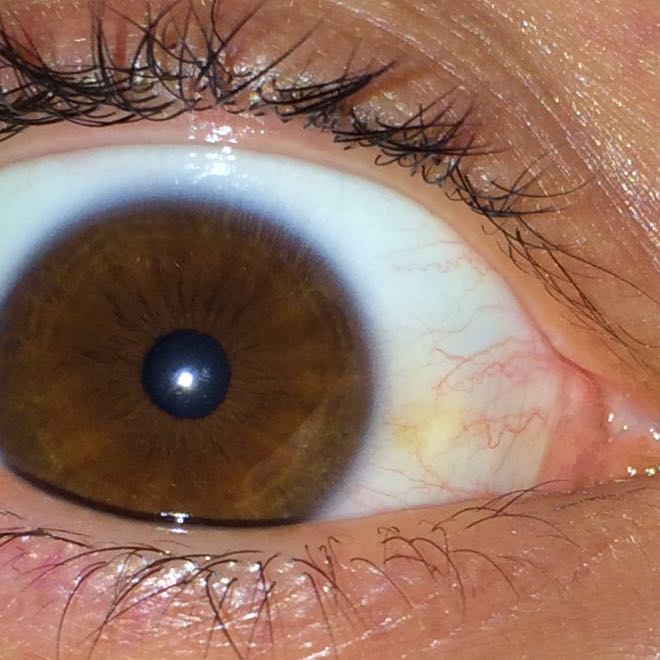 War öfter feiern, kommt dieser gelbe Stich im Auge vom Alkohol? Trinke eigentlich nie extrem