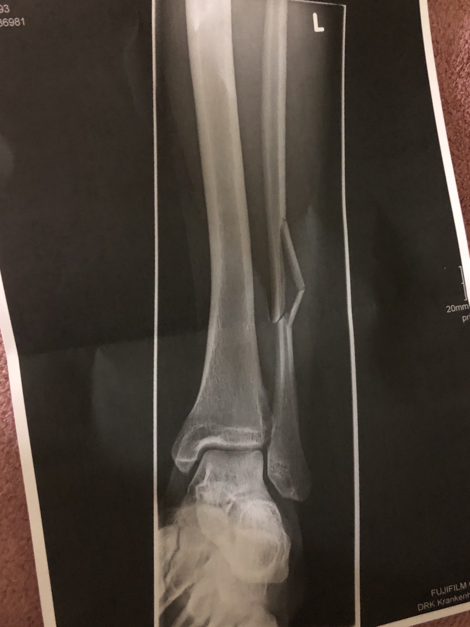 Wadenbeinbruch operiert werden? (Gesundheit und Medizin, Arzt, Krankenhaus)