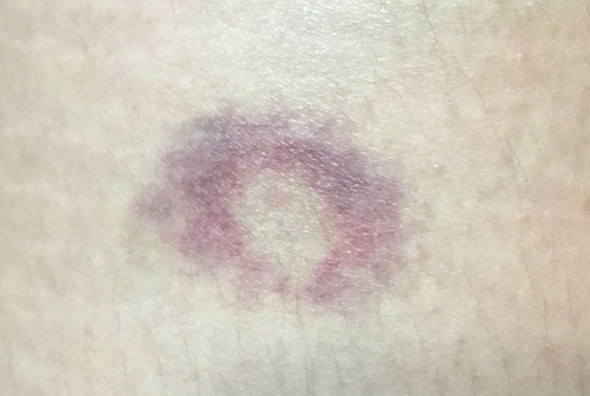 Warum blauer Fleck eine weiße Mitte? (Gesundheit und Medizin, Flecken