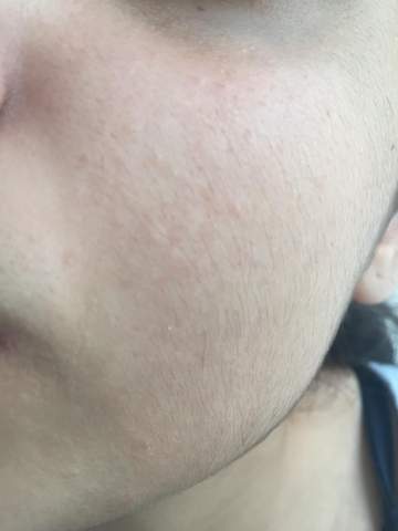 frau so viele haare auf den wangen