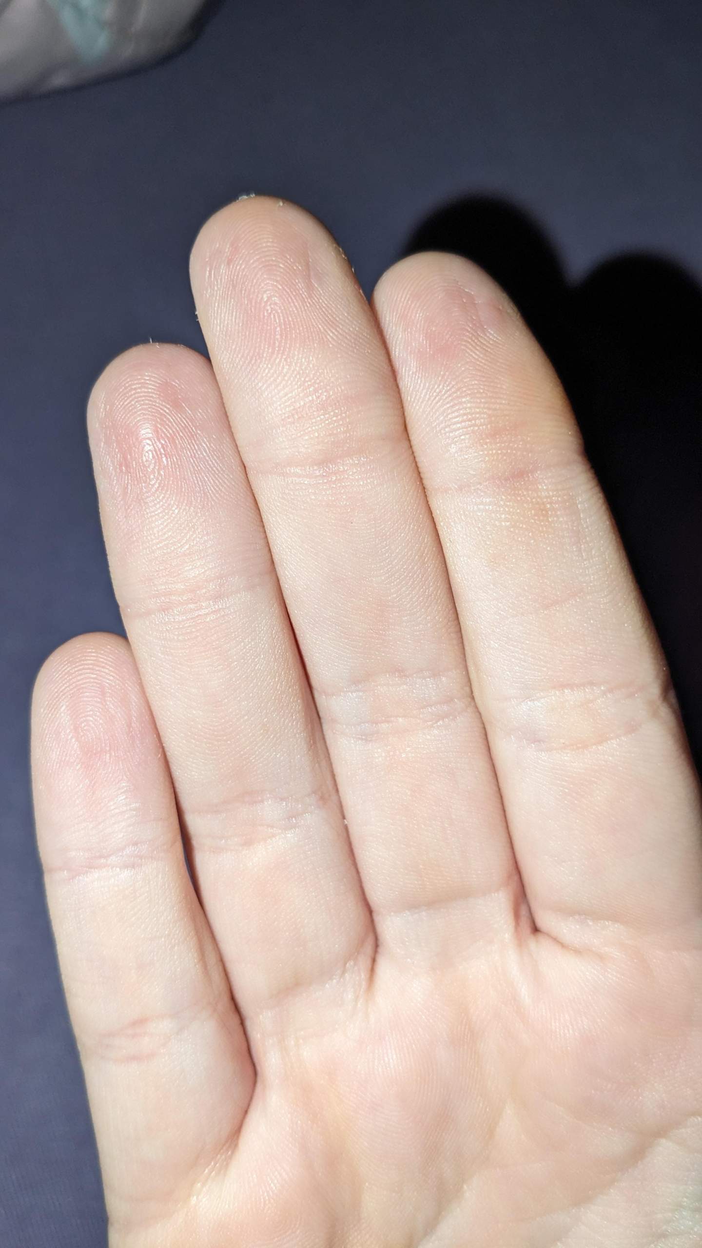 Finger Innen Rillen Warum habe ich falten bei meinen Fingern? (Mädchen, Haut, Hand)