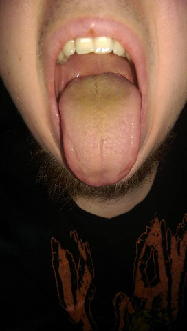 Gelbe Zunge - (Arzt, Krankheit, krank)