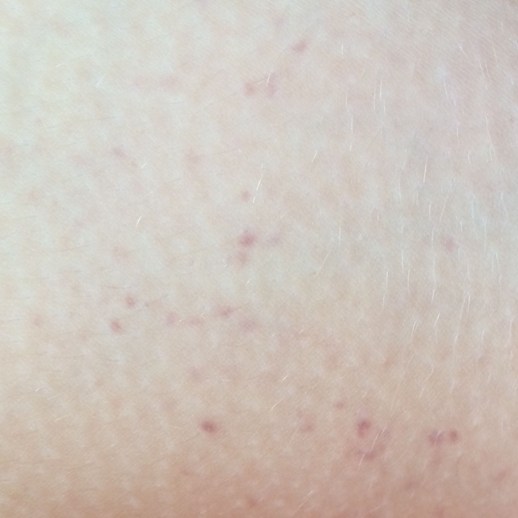 Warum habe ich kleine lila rote Punkte am Bein? (Gesundheit, Flecken