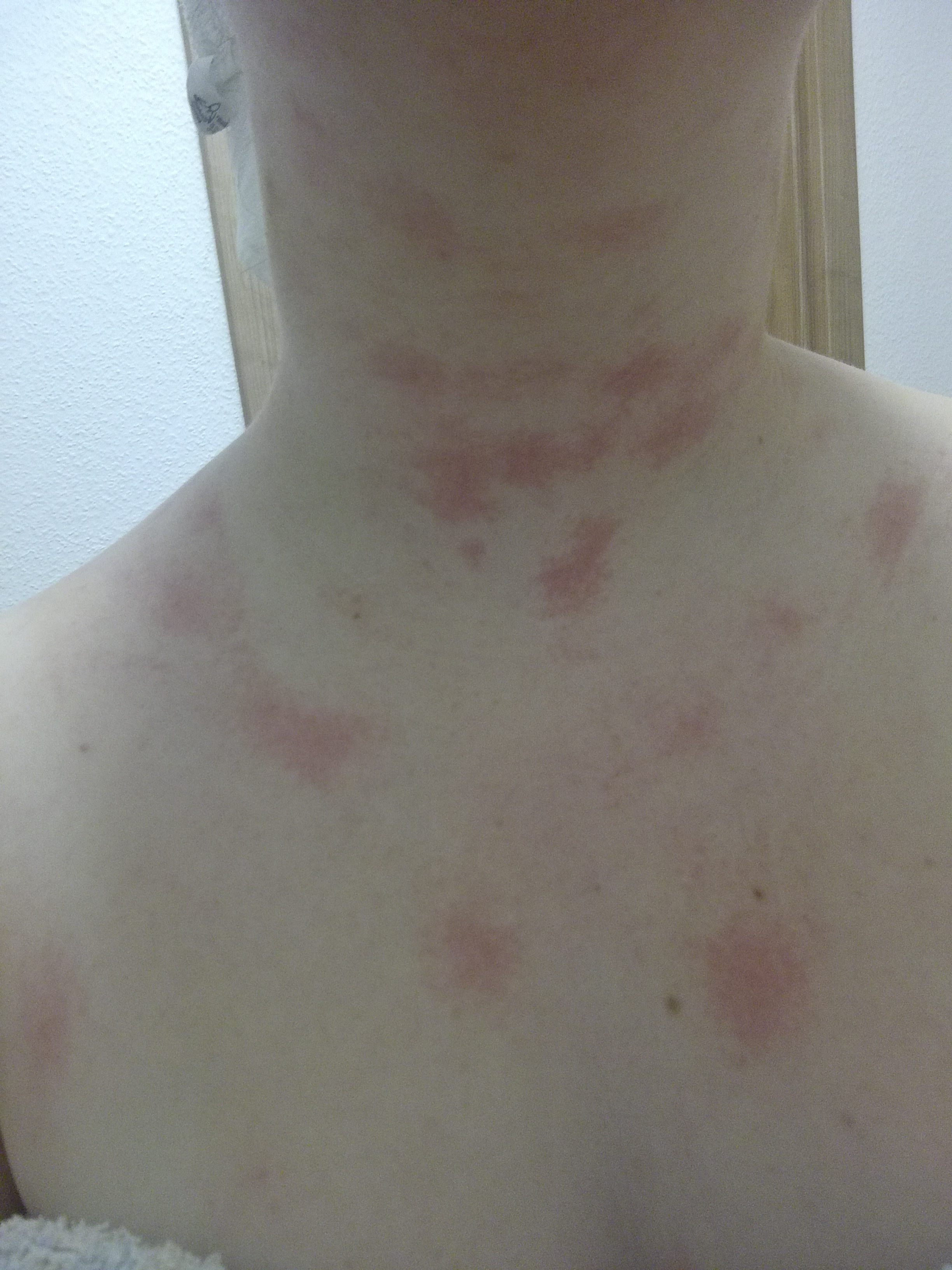 Warum habe ich nachdem Duschen am Rücken, Hals so komische rote Flecken ...