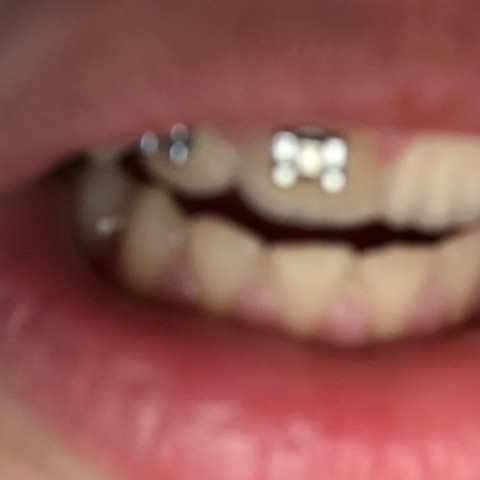 Zähne  - (Zahnspange, Kieferorthopädie, Brackets)