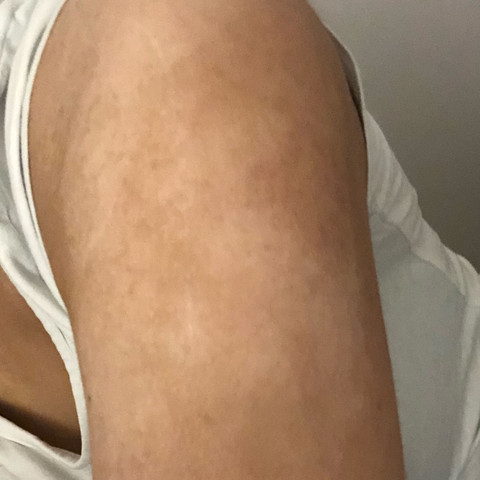 Warum Habe Ich So Trockene Weiss Hinterlegte Hautstellen Gesundheit Und Medizin Trockene Haut Rau Warum Habe Ich So Trockene Weiss Hinterlegte Hautstellen Gesundheit Und Medizin Trockene Haut Rau