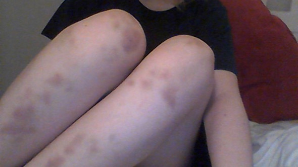 Warum Habe Ich So Viele Blaue Flecken D Beine Bluterguss Blaue Flecken Warum Habe Ich So Viele Blaue Flecken D Beine Bluterguss Blaue Flecken