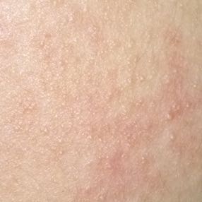 Pickel im gesicht become hilft become hilft wirklich gegen pickel im gesicht