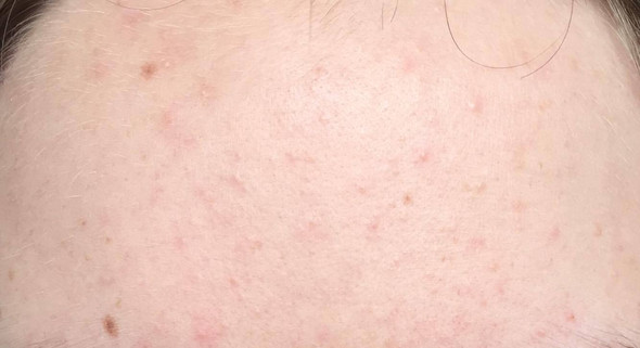 Warum Immer Wiederkehrende Pickel Auf Der Stirn Wasser Bekampfen