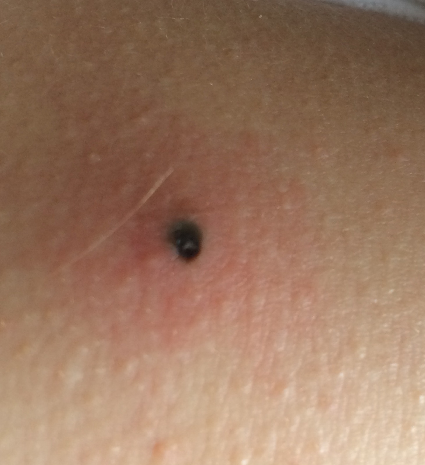 Download Dunkle Flecken Nach Pickel Gif