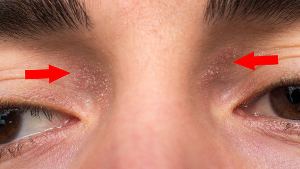 trockene juckende Haut über den Augen - (Gesundheit, Krankheit, Haut) .