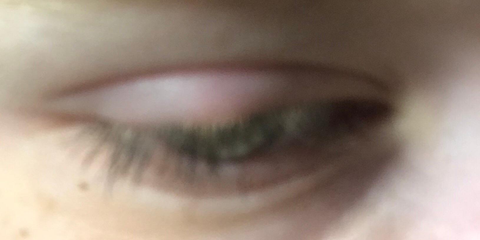 Warum ist mein Auge angeschwollen? (Gesundheit und Medizin, Gesundheit