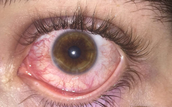 Auge - (Gesundheit und Medizin, Augen, rot)