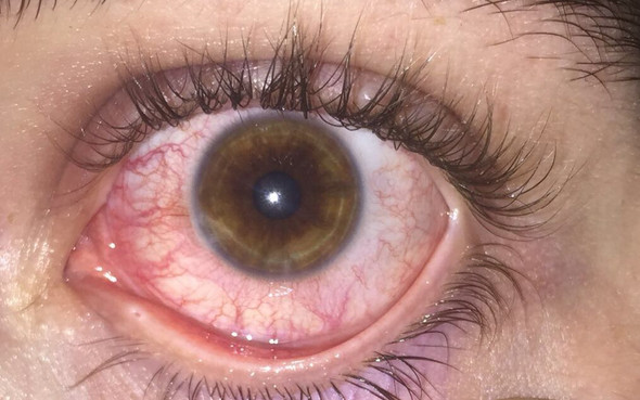 Warum Ist Mein Linkes Auge So Gerotet Gesundheit Und Medizin Augen Rot Warum Ist Mein Linkes Auge So Gerotet Gesundheit Und Medizin Augen Rot
