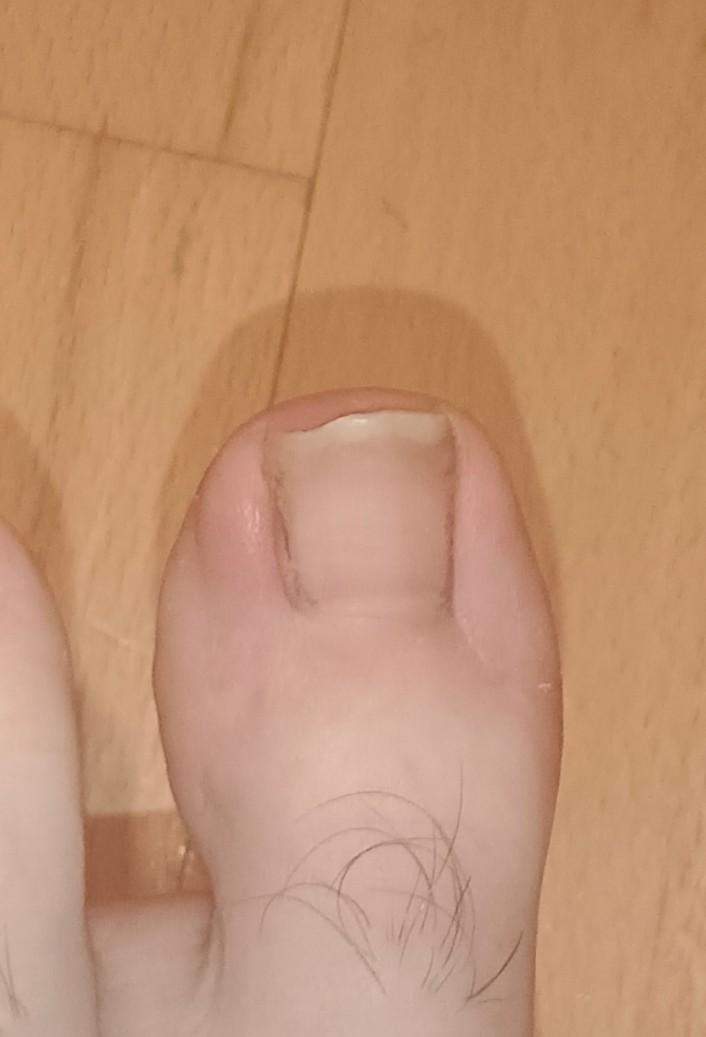 Warum ist mein Zeh so geschwollen? (Pflege, Zehennagel)
