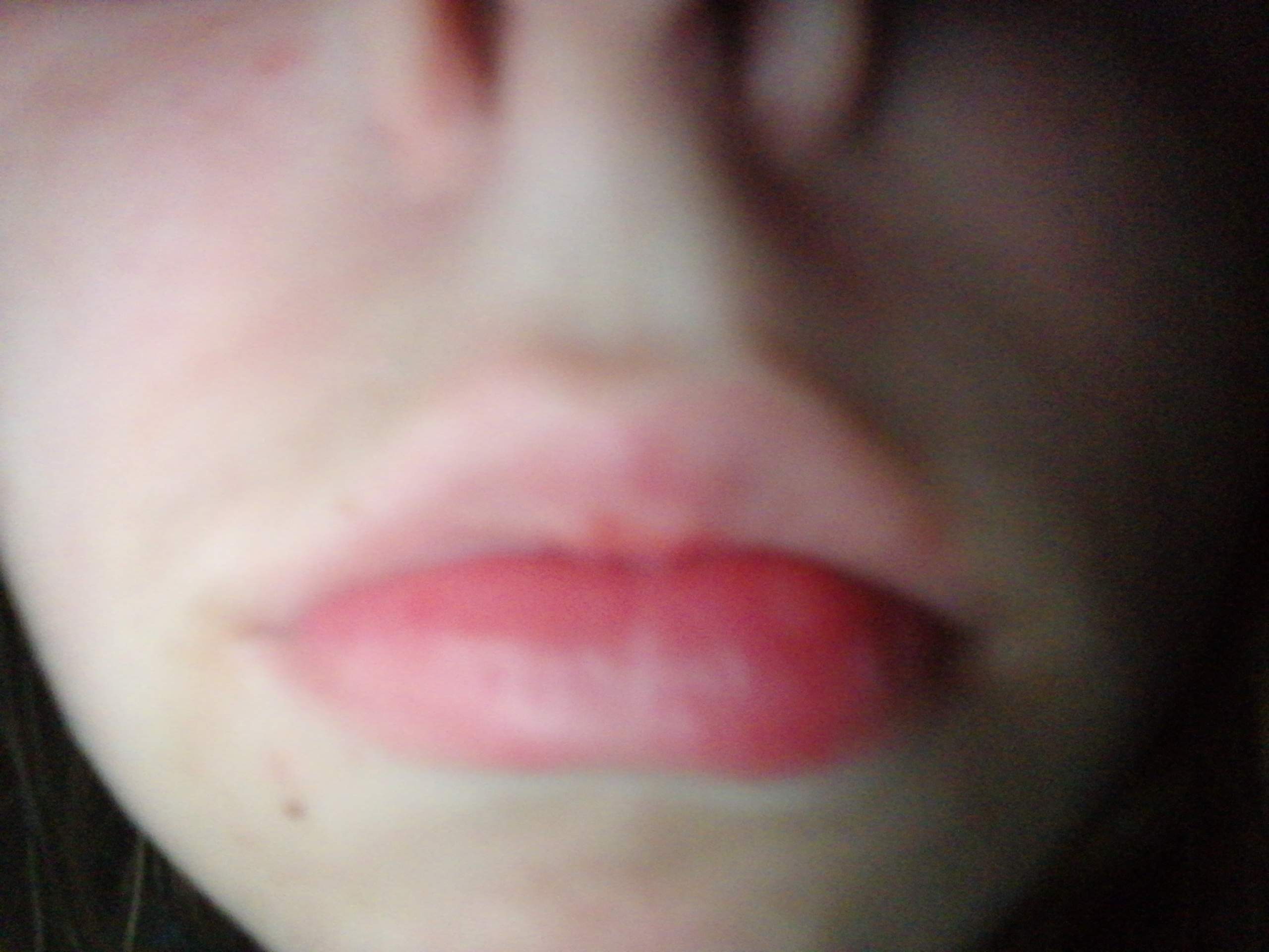 An schwillt allergie lippe Geschwollene Zunge