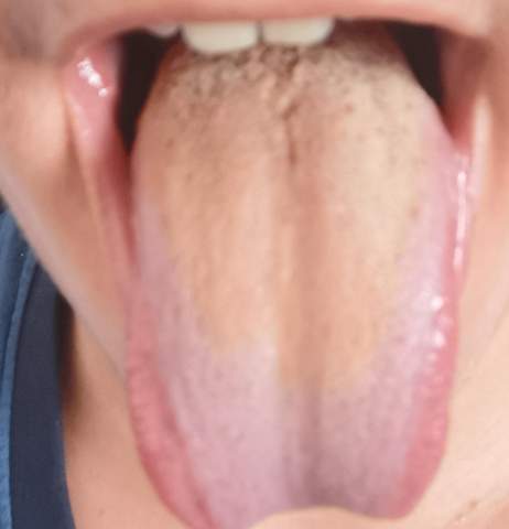 Warum ist meine Zunge gelb verfärbt?