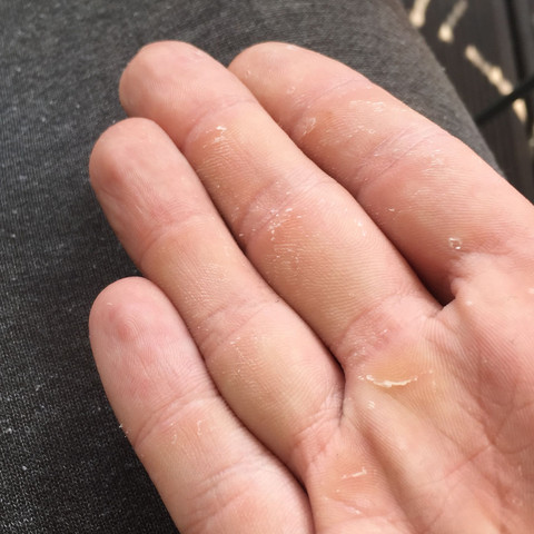 Warum Lost Sich Meine Oberste Hautschicht Auf Den Handen Ab Gesundheit Und Medizin Krankheit Haut Warum Lost Sich Meine Oberste Hautschicht Auf Den Handen Ab Gesundheit Und Medizin Krankheit Haut