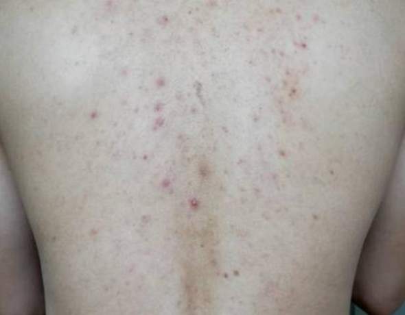 Warum Rote Flecken Am Rucken Medizin Haut Pickel