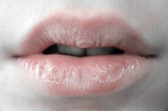 trockene lippen - (Lippe, Neurodermitis)