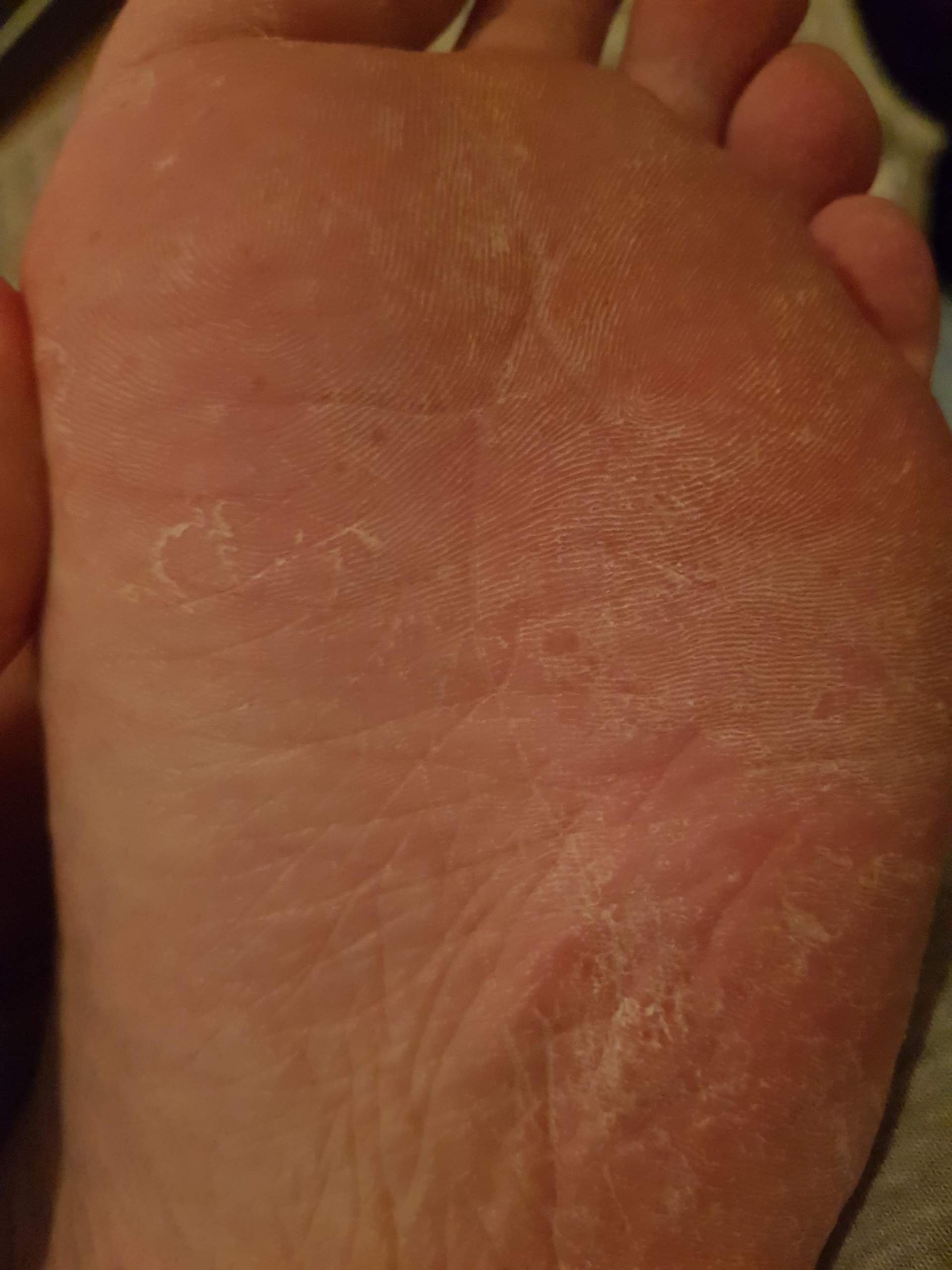 Warum schält sich mein linker Fuß (rote Punkte)? (Gesundheit, Arzt, Haut)