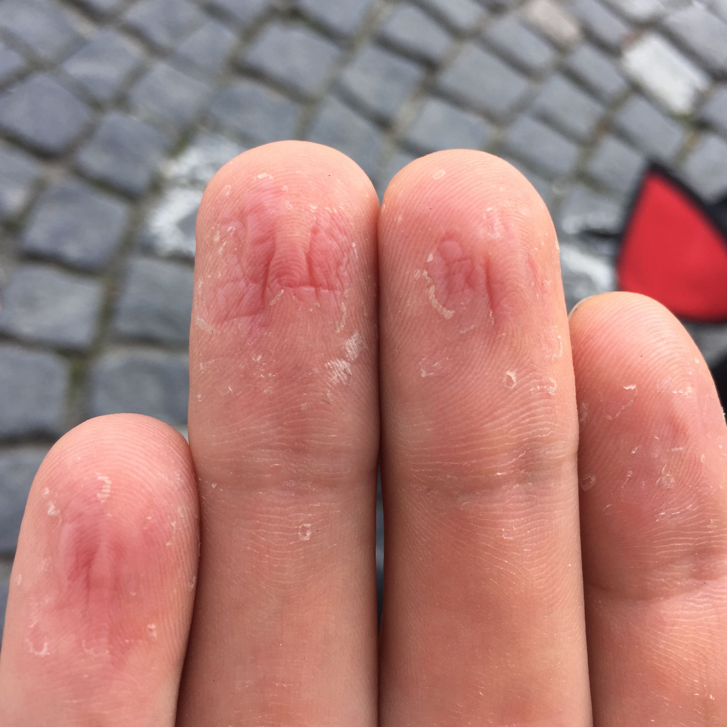 Haut lost sich von den fingerkuppen