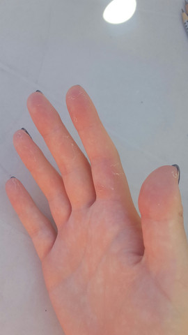Warum Schalt Sich Nach Und Nach Meine Haut An Der Hand Bild Gesundheit Warum Schalt Sich Nach Und Nach Meine Haut An Der Hand Bild Gesundheit