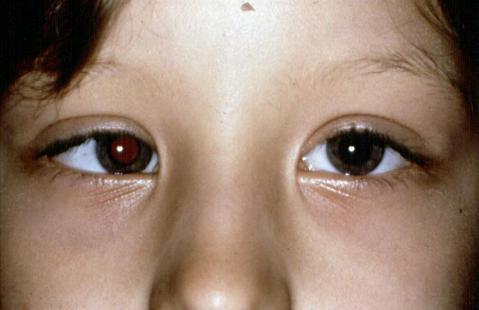 Warum Sehen Meine Augen Unabhangig Voneinander Brille Schielen