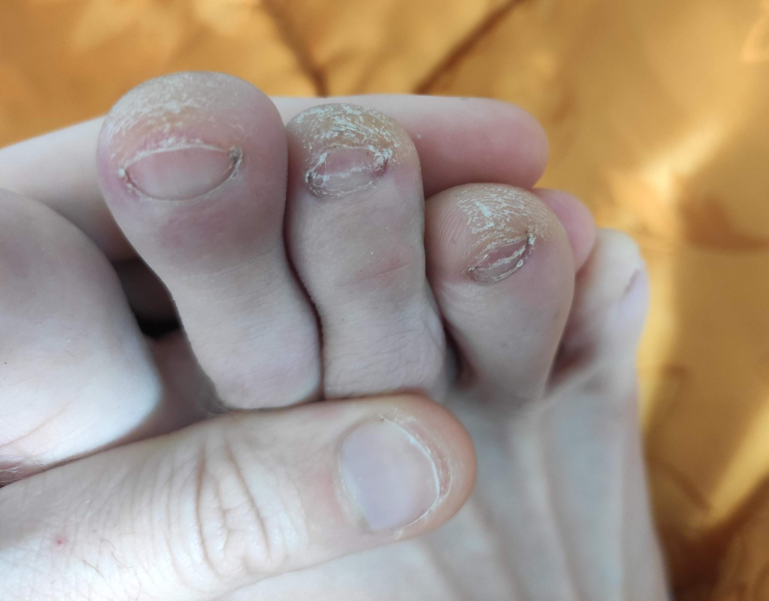 Warum sehen meine Zehenspitzen so komisch aus (Gesundheit, Hornhaut, Zehnägel)? (Zehennagel)