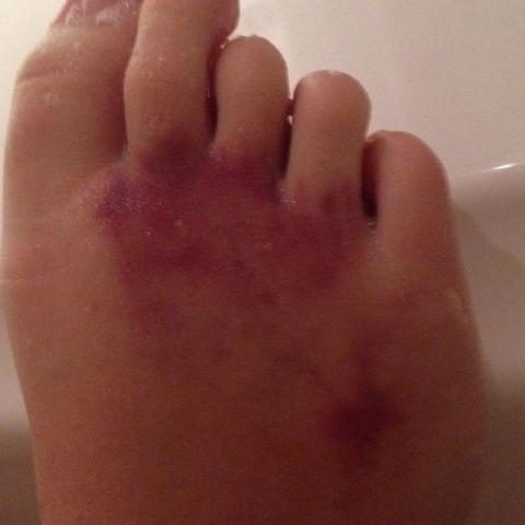 Das obere an meinen Zehen ist nach Sport dazu gekommen Rest des Fußes ist blau - (Füße, Bluterguss)