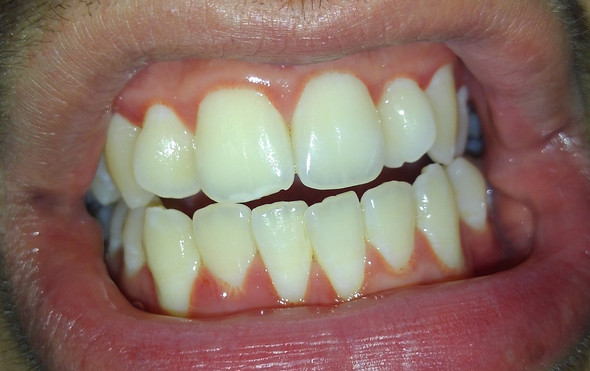 Ich hatte schon immer Probleme mit meinem Zahnfleisch, da dieser sehr empfindlic - (Zähne, Zahnfleisch)