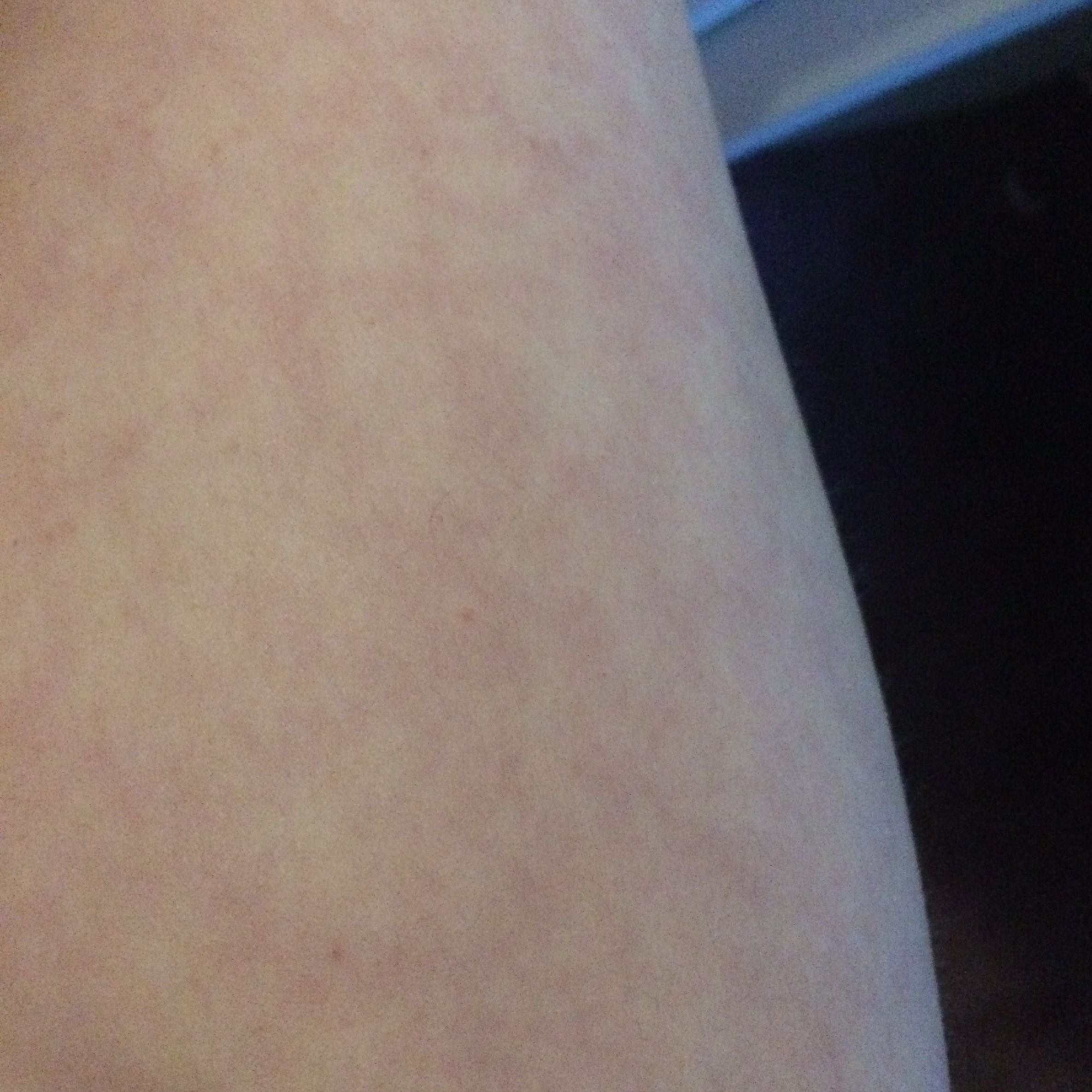 Warum sind rote Flecken an meine Beinen (siehe Bild)? (Mädchen