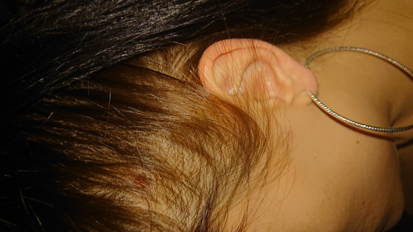 wenig haardichte haare haarausfall