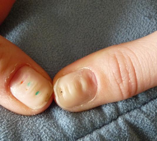 Warum Verformen Sich Die Nagel Beauty Fingernagel Nagelhaut