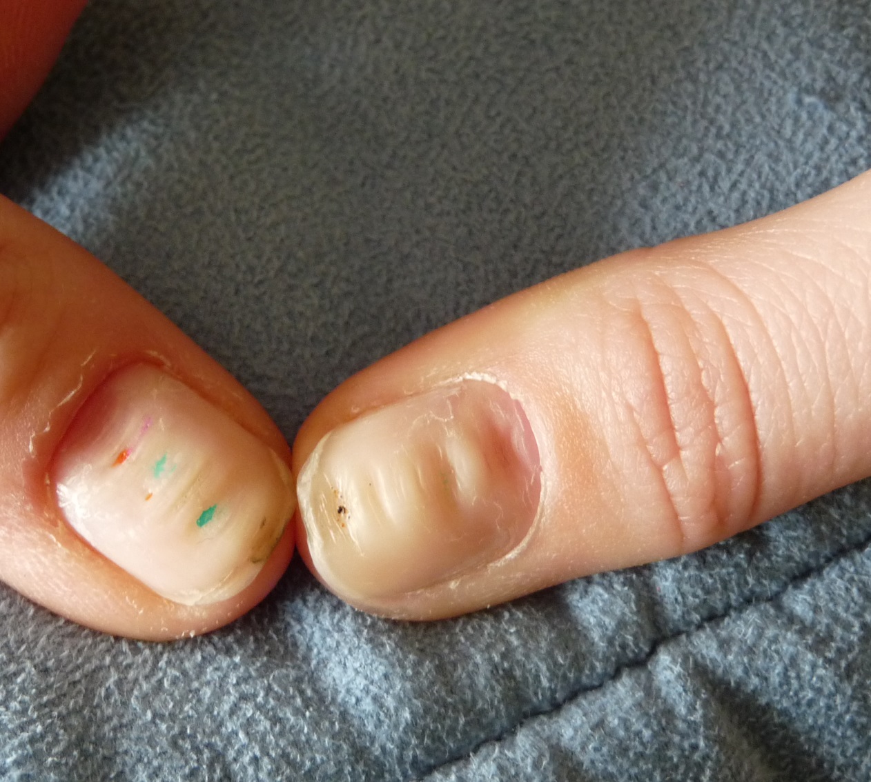Warum verformen sich die Nägel? (Beauty, Fingernägel, nagelhaut) Warum verformen sich die Nägel? (Beauty, Fingernägel, nagelhaut)