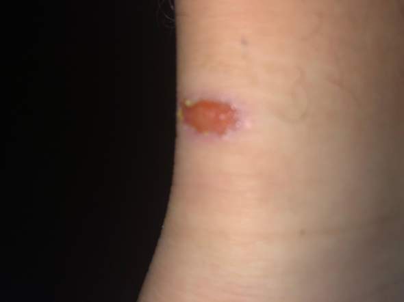 Warum Verheilt Die Wunde Nicht Gesundheit Und Medizin Fusse Warum Verheilt Die Wunde Nicht Gesundheit Und Medizin Fusse