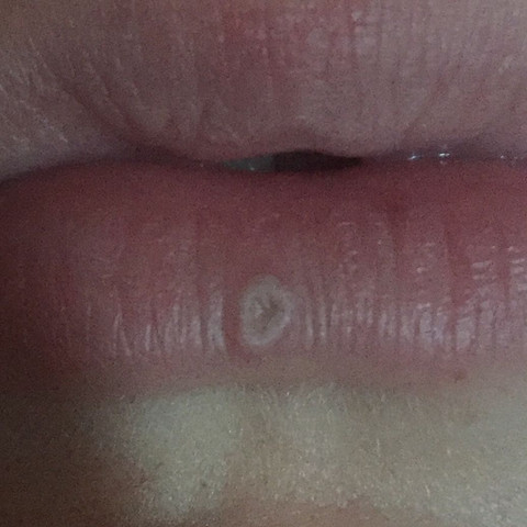 wie es meistens aussieht wenn ich trockene Lippen habe - (Gesundheit und Medizin, Arzt, Krankheit)