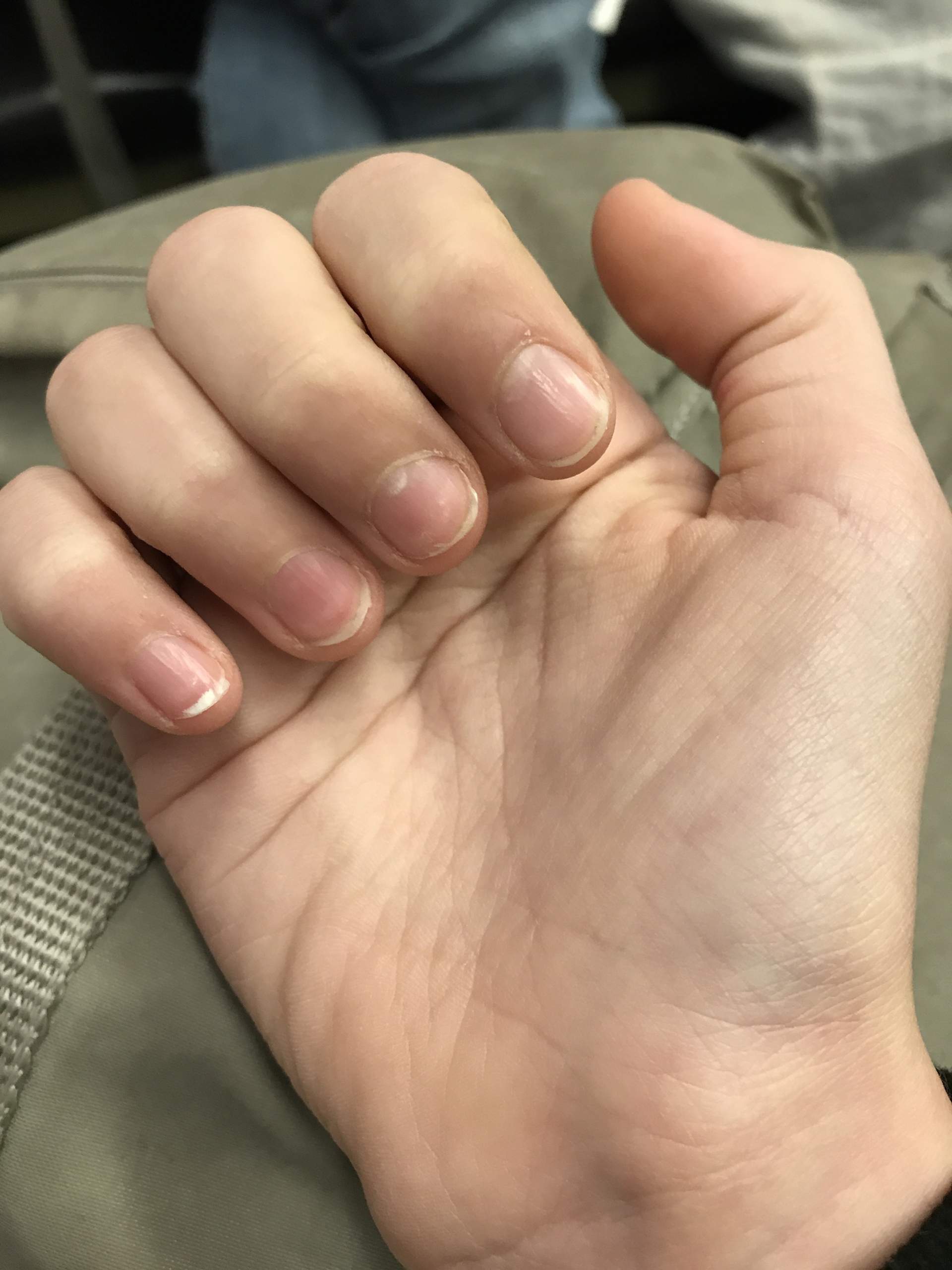 Warum wachsen meine Nägel so komisch in die Breite? (Fingernägel)
