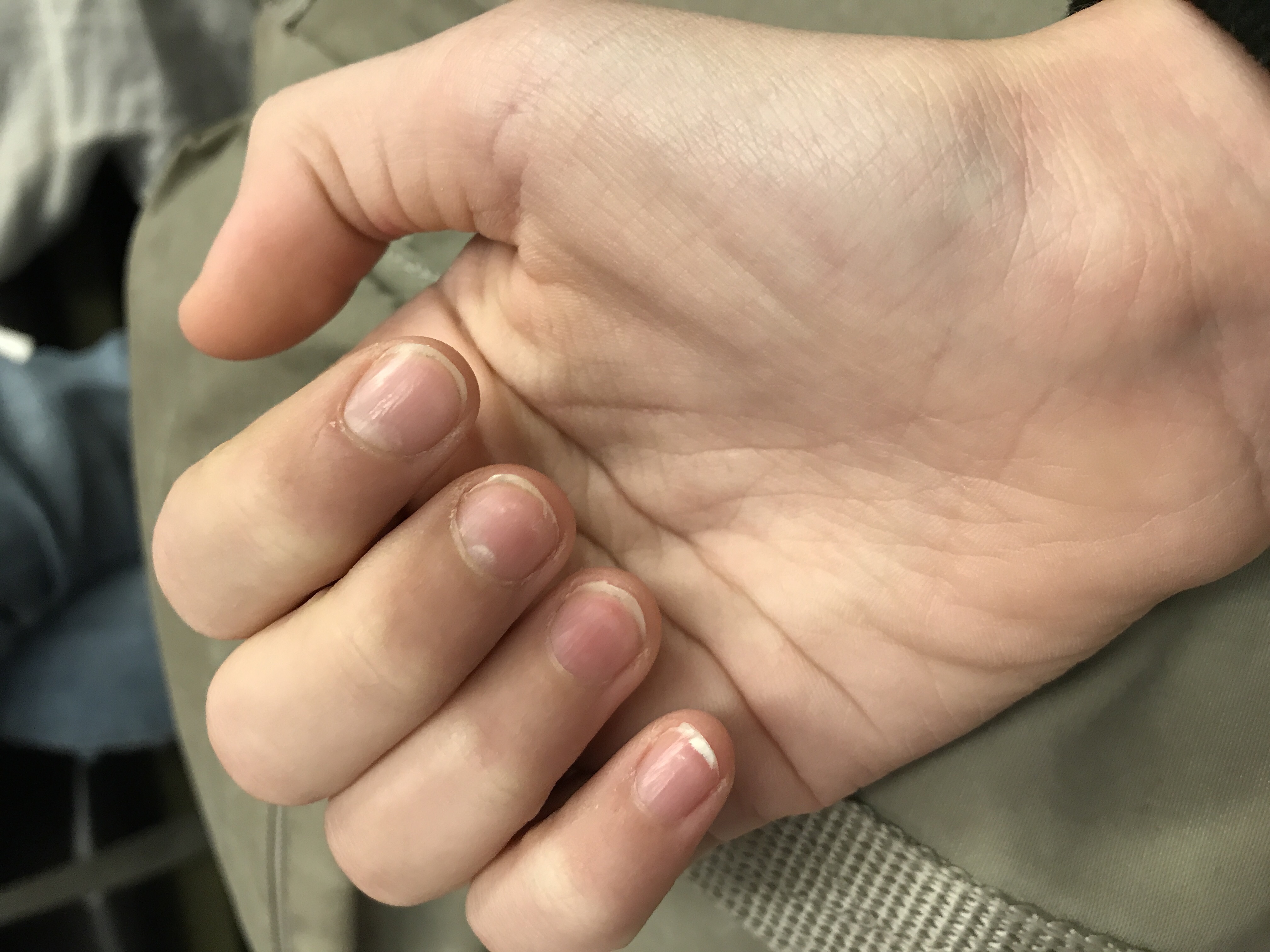 Warum Wachsen Meine Nagel So Komisch In Die Breite Fingernagel