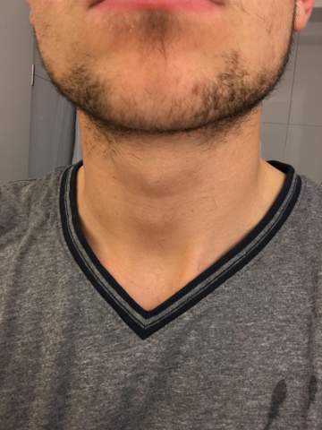 Wangen den bartwuchs kein an Kein Bartwuchs
