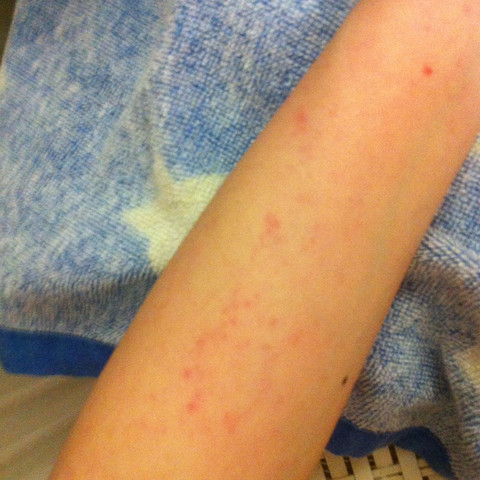 Warum Werden Meine Arme So Nach Dem Ich Dusche Brennen Duschen Jucken Warum Werden Meine Arme So Nach Dem Ich Dusche Brennen Duschen Jucken